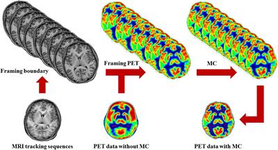 MRI-Driven PET Image Optimization for Neurological Applications